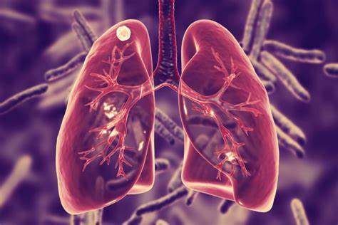 Tuberkuloza – bolest s kojom ćemo se boriti još godinama